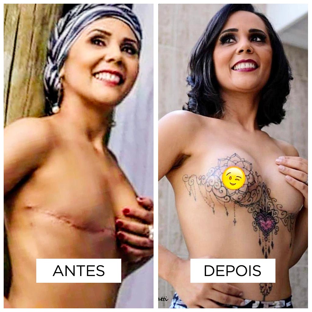 Cobertura de cicatriz – Mastectomia
