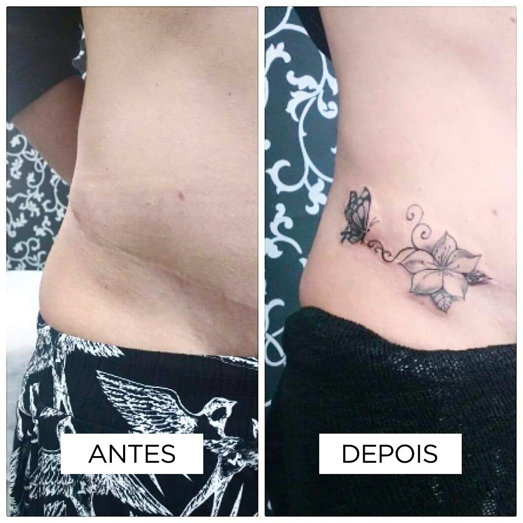 Cobertura de cicatriz – Cesárea