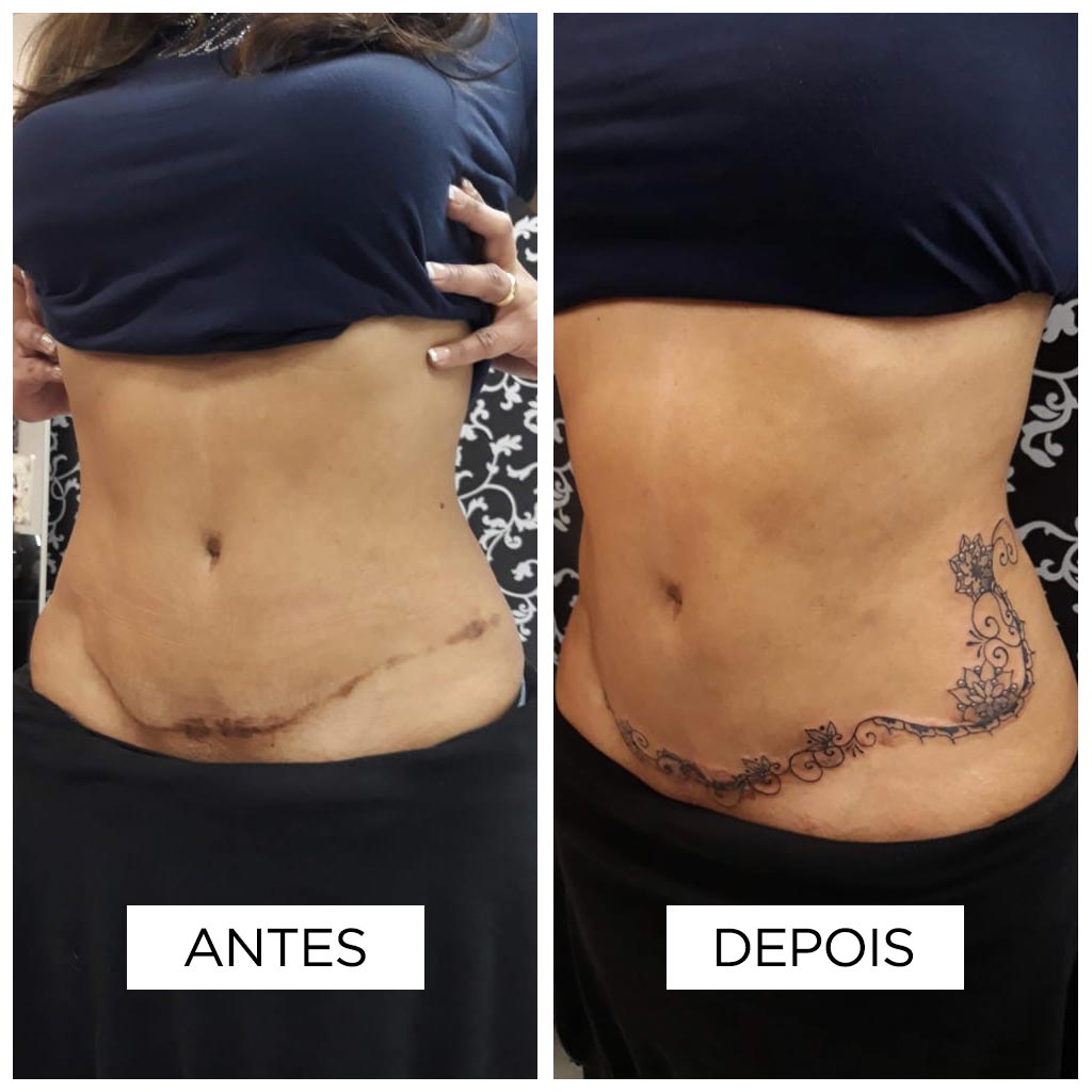 Cobertura de cicatriz – Abdominoplastia