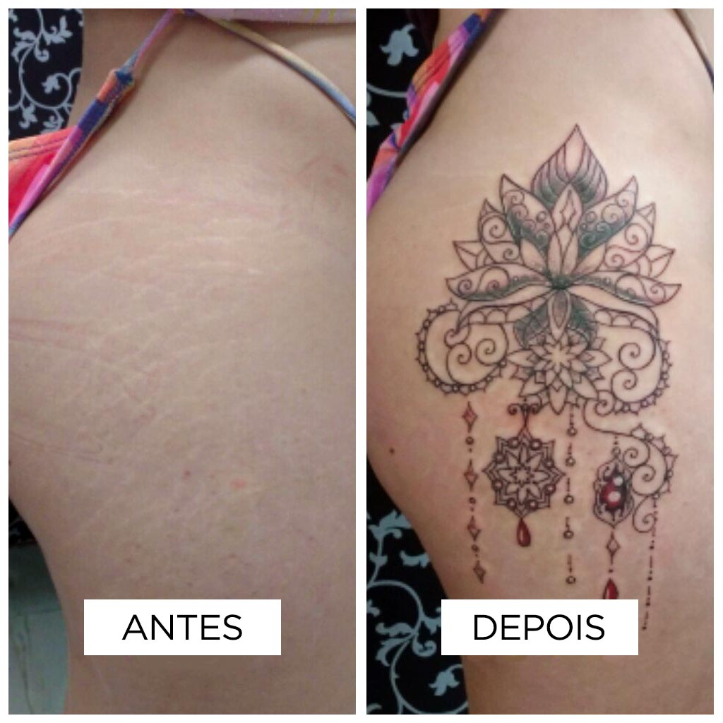Cobertura de cicatriz – Estrias Cobertura de cicatriz – Estrias