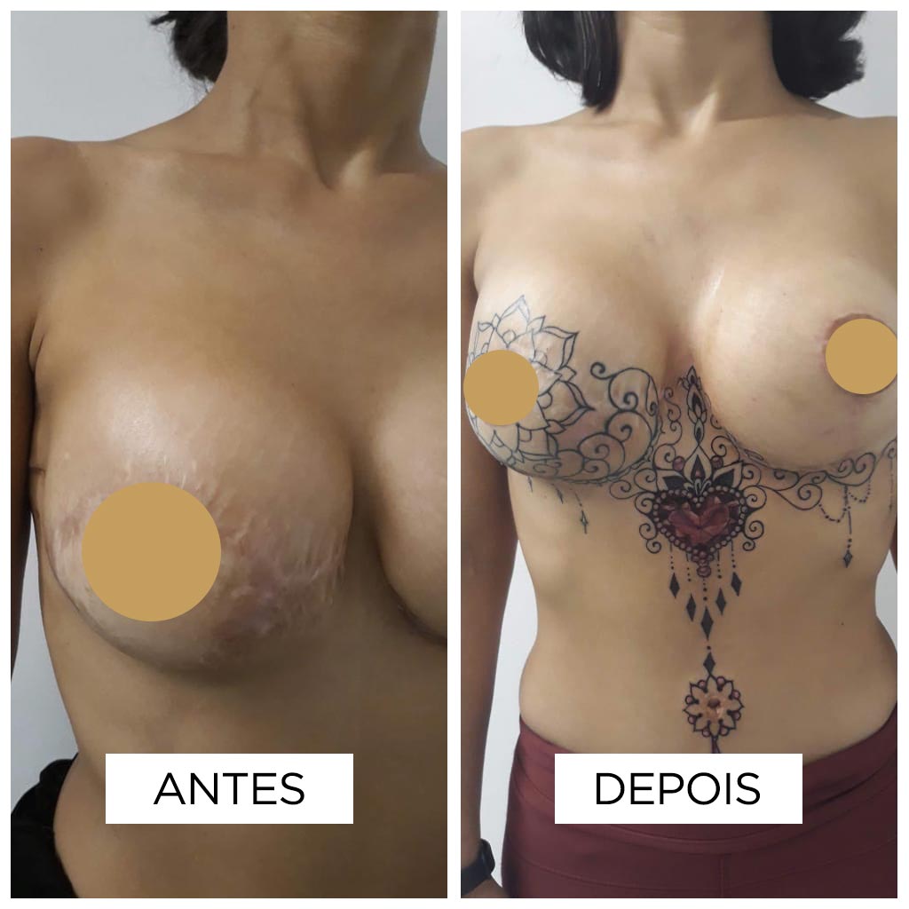 Cobertura de cicatriz – Mastectomia Cobertura de cicatriz – Mastectomia