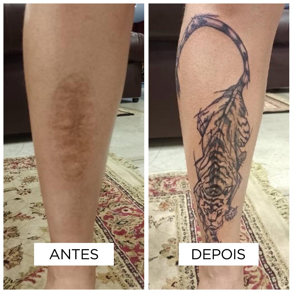 Cobertura de cicatriz – Queimadura Cobertura de cicatriz – Queimadura