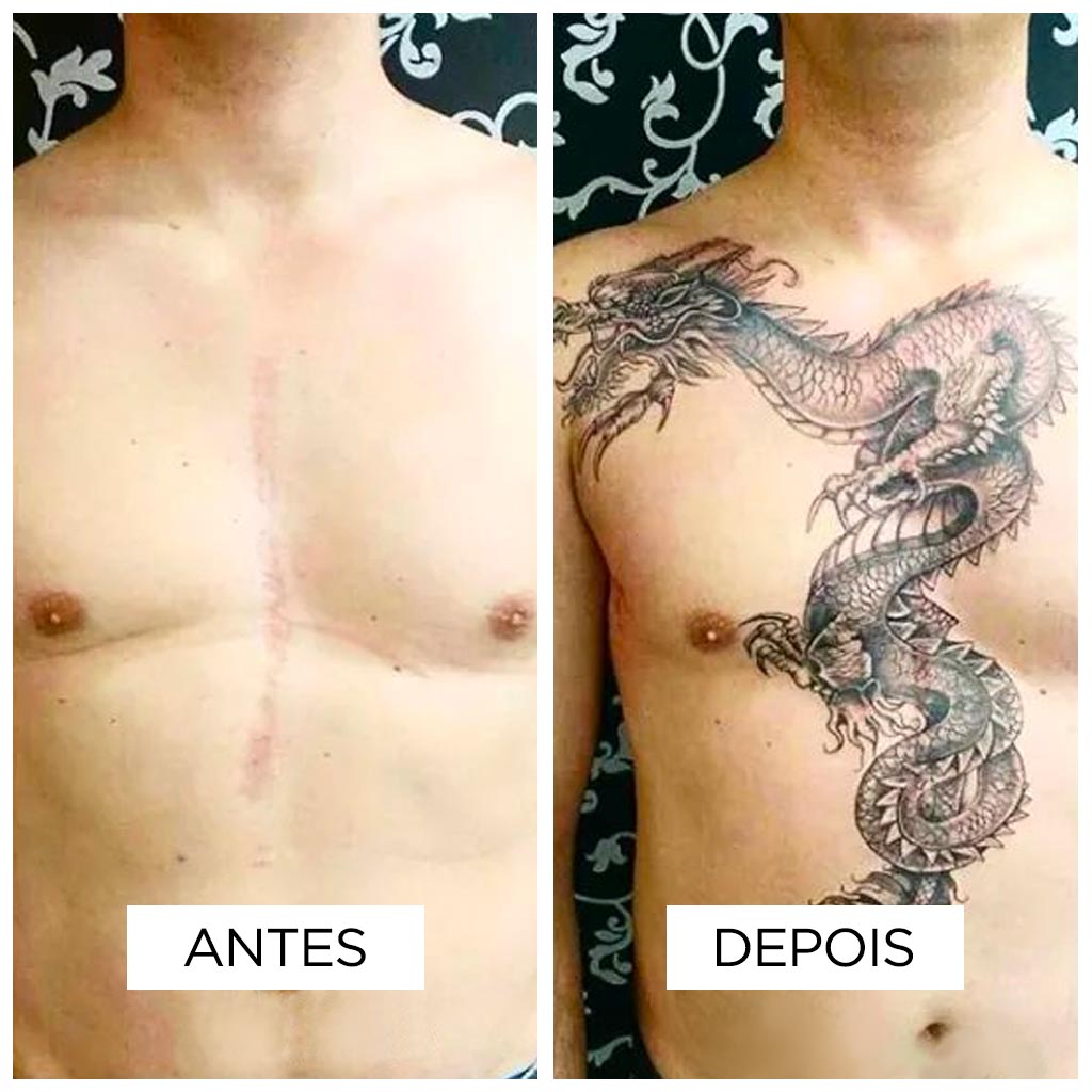 Cobertura de cicatriz – Torácica