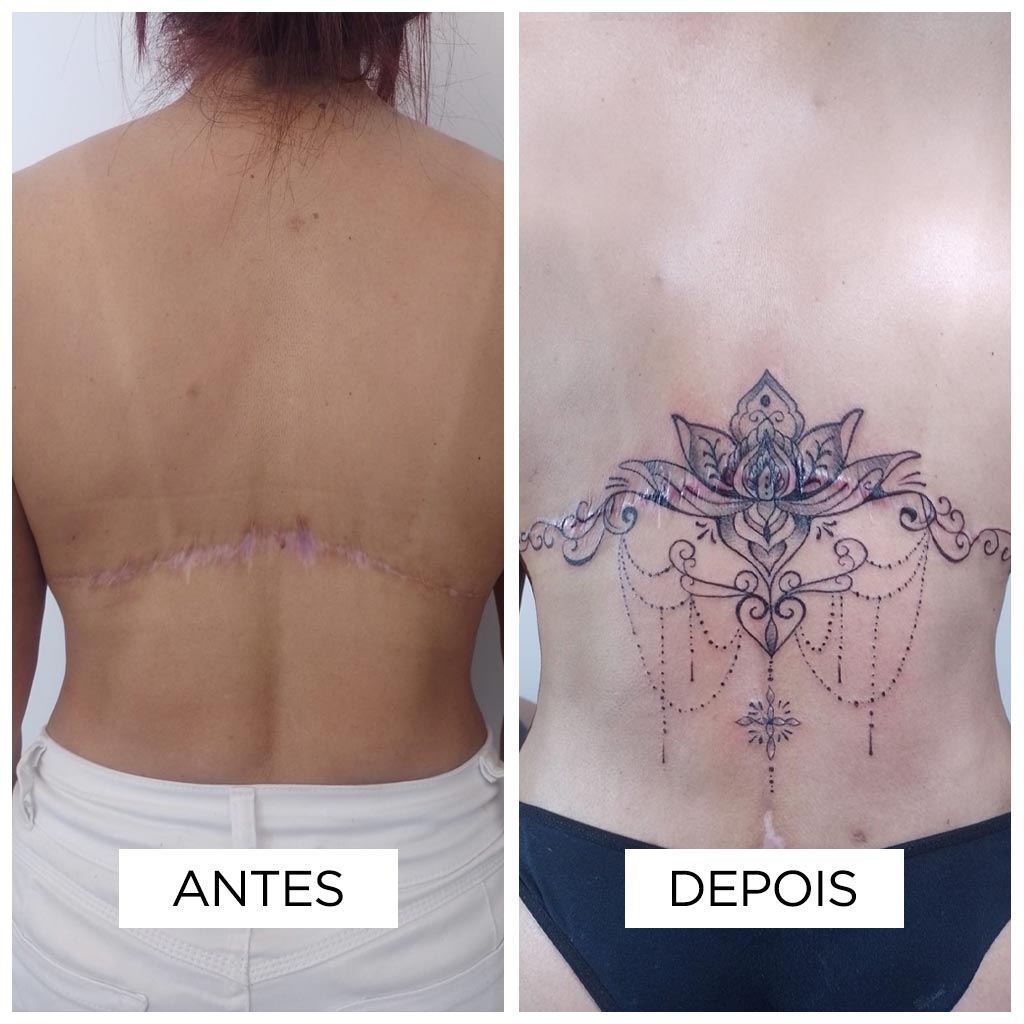 Cobertura de cicatriz – Torsoplastia